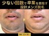 【ヒゲ全体+首】ムダな回数をかけない「設計脱毛」¥14,500→初回¥12,000