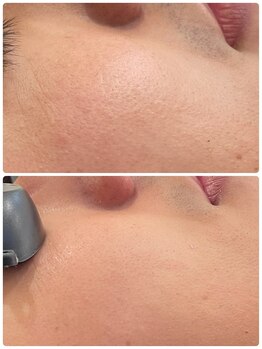 エン(enn)/【髭・美肌・毛穴緩和】