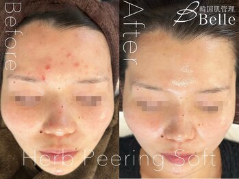 ベル 目黒(Belle)/ハーブピーリング|ニキビケア