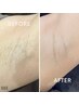 【学割U24】気になる両脇も可能！　Sパーツ脱毛(2回分)　2200円