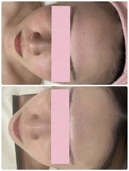 レイビス 仙台店(RAYVIS)/毛穴洗浄+美白+小顔