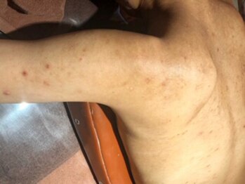 Cocotii 大阪店(ココティー)の写真/グリーンピールボディ両腕側面A4サイズ¥33000→¥26400/肩含むor前腕 A4+片手の平サイズ¥44000→¥35200◎