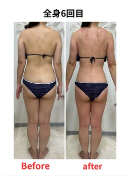 ステラ(Stella)/痩身6回目