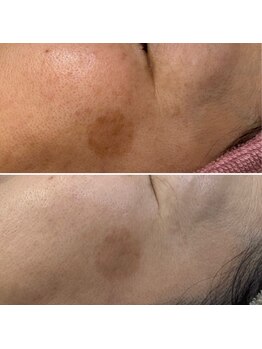 じぶんniプラス/常滑/フェイシャル/シミ/たるみ