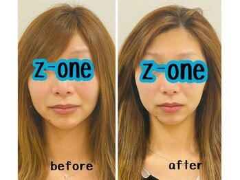 うつくし痩身 美サロン ゼットワン(Z-ONE)/before　after