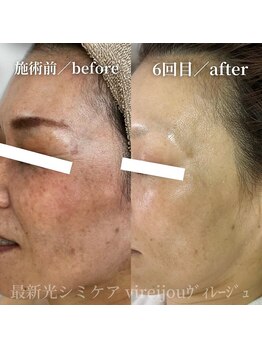 プライベートアイラッシュサロン ヴィレージュ 稲毛店(Vireijou)/大人気のシミケアで悩み解決！