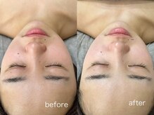 パールフェイスエステ ルペルル(PEARL FACE ESTHE la perle)/リバイタライズコース