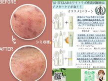 ベリル(BERYL)/シミ回収！！後が最も重要！