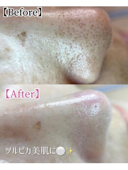 ゴールド 栄店(GOLD)/毛穴洗浄コース ５回後