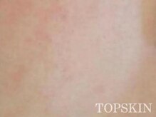 トップスキン 久屋大通(TOPSKIN)/毛穴レスなたまご肌に♪