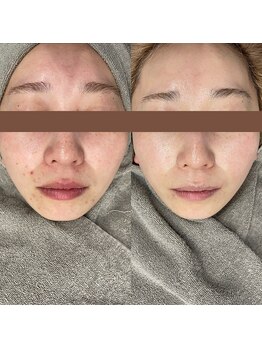 レベンディス(LEVENDIS)/光フェイシャル×ハーブ　