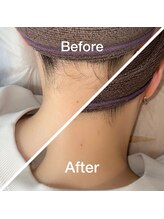 ピンキー 中野(pinky)/うなじ脱毛