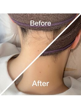 ピンキー 中野(pinky)/うなじ脱毛