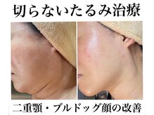 エスビューティー 三軒茶屋(S beauty)の雰囲気（たるみ・ほうれい線・二十顎・ブルドック顔も見違える程に美しく）