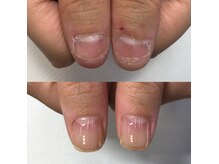 噛んでしまったり、毟り癖、深爪でお悩みの方もお任せください！