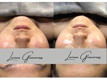 ラリマ グラマラス(Larima Glamorous)/ピーリング＋美容成分導入