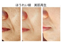 エボルブ 四条烏丸店(EVOLVE)の雰囲気（リンパフェイシャル＆ヒト幹細胞でホウレイ線もふっくら！）