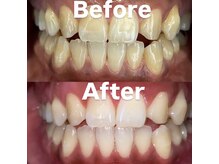 ホワイトニングビューティー 光の森店(WHITENING BEAUTY)/ホワイトニング♪
