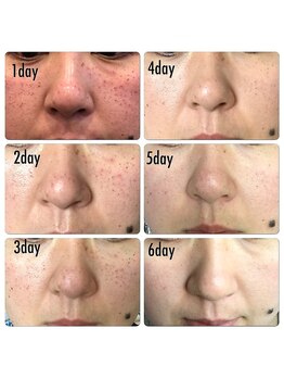 トラット エステアンドアイズ(tratto)/30代　お客様症例写真