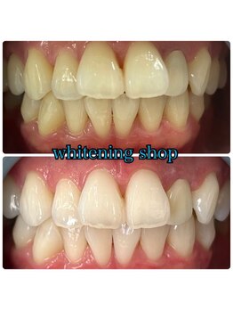 ホワイトニングショップ 鈴鹿店/Before&After美白ホワイトニング