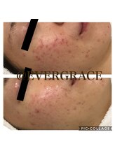 エヴァーグレース 川崎店/長年お悩みのニキビにアプローチ