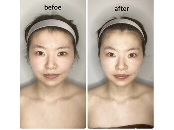 らくカモ/【1回の施術】before after