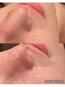 ウォーム(Warm)/20代　毛穴エクストラクション