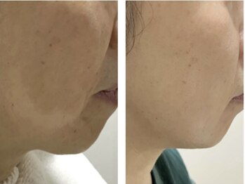 ジョアン(Johan)/艶肌フェイシャル★