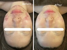 レイ(REI)/◆ニキビケア・敏感肌◆