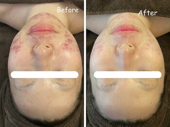 レイ(REI)/◆ニキビケア・敏感肌◆