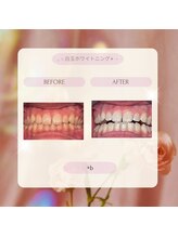 プラスビー 2号店(+b)/ホワイトニングビフォーアフター