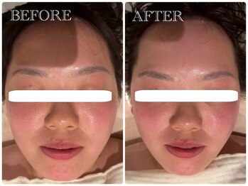 シュシュ(chouchou)/1度の小顔矯正