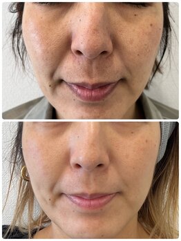 ピーナップ(P-nap)/たるみ、毛穴改善