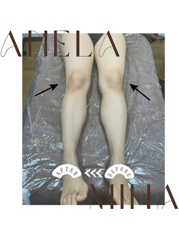 アーネラミーナ(Anela mina)/骨盤、矯正骨の調整の施術例です