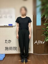 たか施術院/頭が痛い 背中の痛み 20代 ～3回