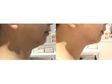 スキンラボ 新宿(@SkinLabo)/W強力ハイブリッドリフト