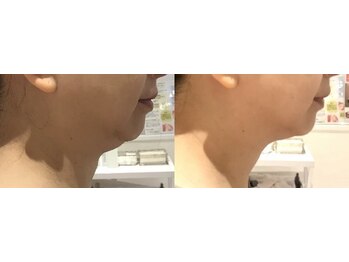 スキンラボ 新宿(@SkinLabo)/W強力ハイブリッドリフト