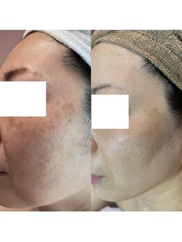 由縁/肌改善プログラム