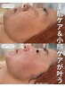 プラズマシャワー＋美容液＋プラズマリフト＋シミケア15分☆初回9500円