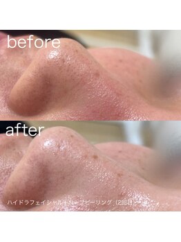 ルルラ リコ(lulula rico)/症例写真/ハイドラ毛穴洗浄