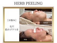 ロージー(ROSY)/ハーブピーリング/阿南/徳島