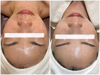 オージャス(OJAS)/40代の方 肌改善★艶玉肌