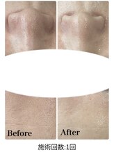 ミセル(MISEL2nd)/黒ずみ毛穴/角栓除去★毛穴洗浄