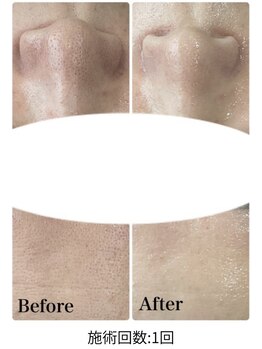 ミセル(MISEL2nd)/黒ずみ毛穴/角栓除去★毛穴洗浄