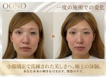 おおの鍼灸接骨院の雰囲気（小顔矯正ビフォーアフター【姫路/小顔矯正美容鍼肩こり】）