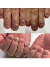 マニュコクーン(ManuCocoon)/爪育成　深爪　巻き爪　大阪市