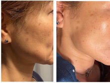 フーレスト アンド フリーリー(Fullest&Freely)/ララピール＆フォト