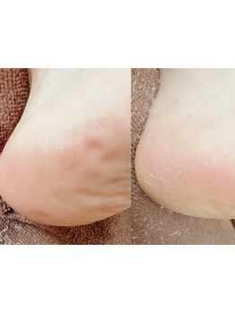 角質ケアができるサロン