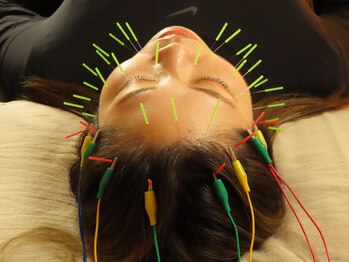 南保/施術風景/美容鍼