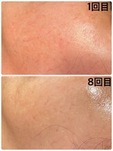 キュアフロウ 橿原店/〈赤ら顔緩和〉気になる悩み◎